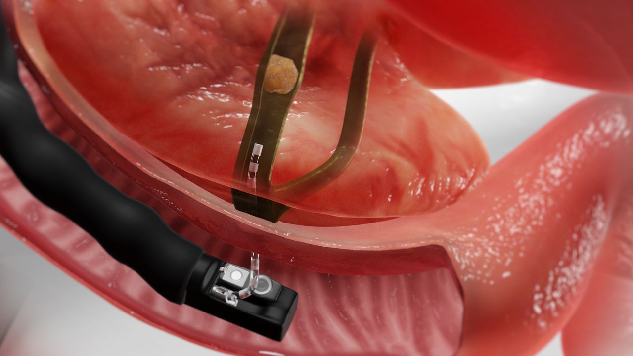 Bronchoscopy in East Delhi